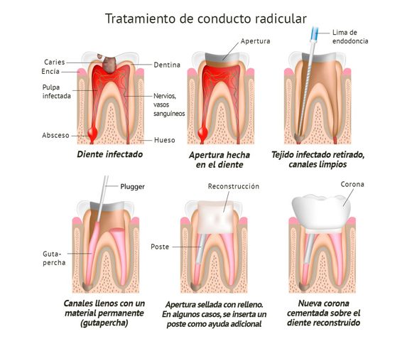 Endodoncia